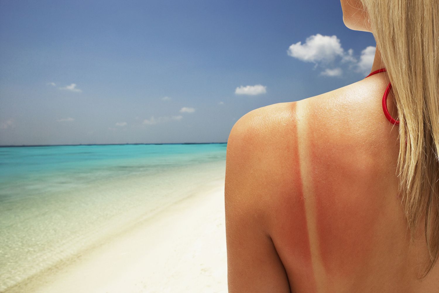 How long does sunburn last
